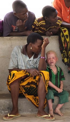 На снимке очень любопытный случай рождения ребенка-альбиноса в чисто африканской семье.